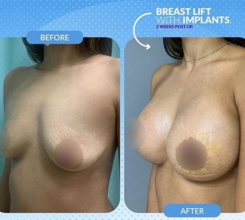 Breast Lift with Implants Before and After Image
