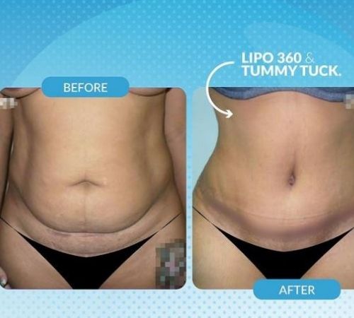 Lipo 360 & Tummy Tuck Before and After Image