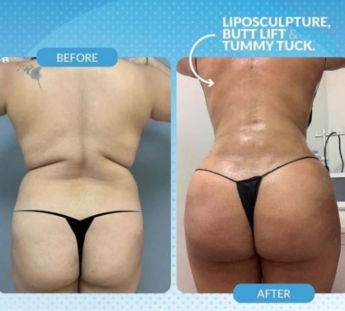 Liposculpture + Butt Lift + Tummy Tuck Before and After Image