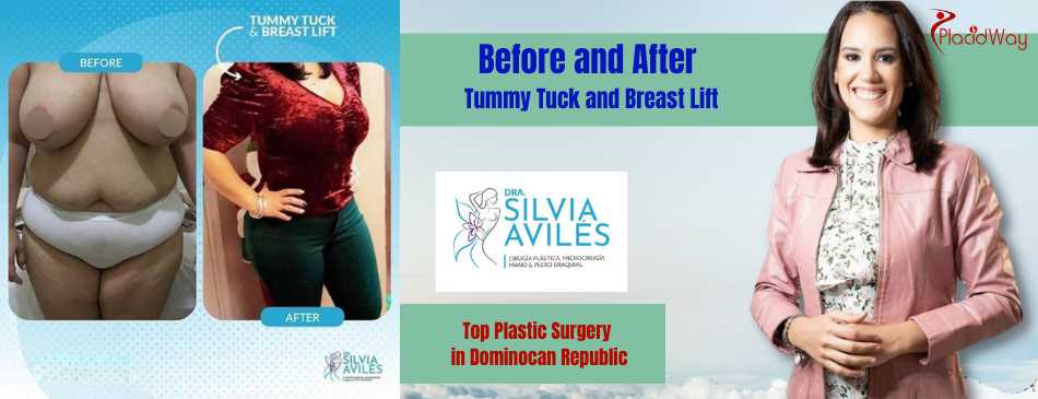 Before and After Tummy Tuck in Dominican Republic 