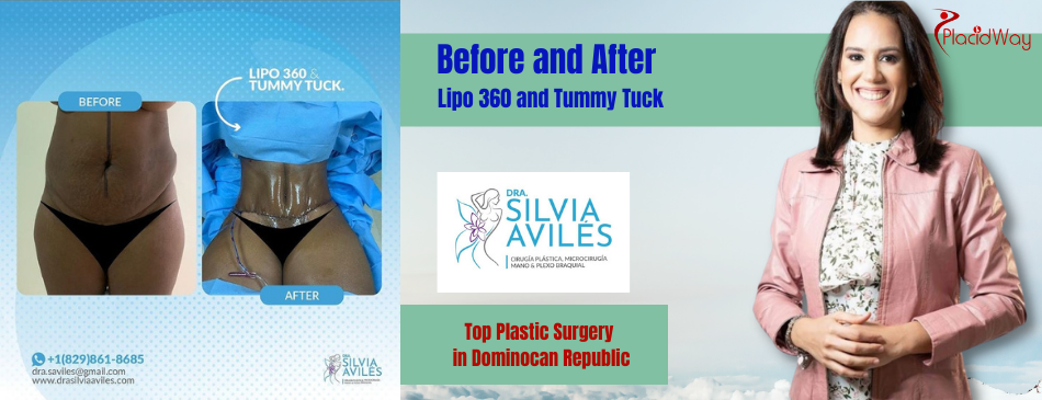 Lipo 360 & Tummy Tuck in Dominican Republic Before & After Images at Dra. Silvia Aviles