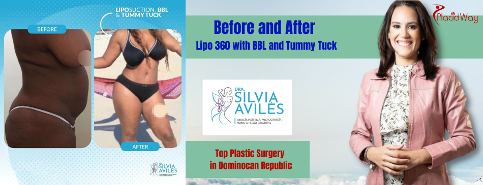 Before and After Tummy Tuck in Dominican Republic 