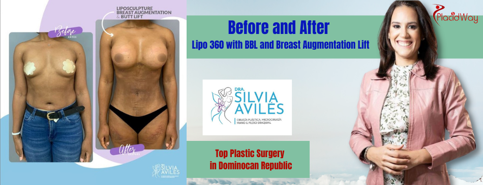 Lipo 360 with BBL and Breast Augmentation Lift in Dominican Republic Before & After