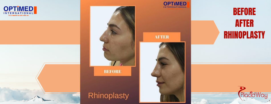 Before and Aftter Nose Jobs in Istanbul Turkey at Optimed International Hospital