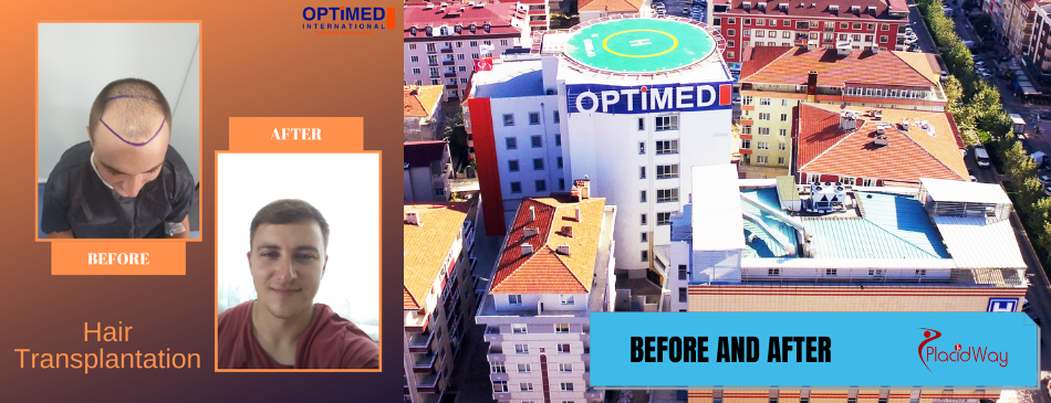 Before and After Hair Transplant in Istanbul Turkey at Optimed Hospital