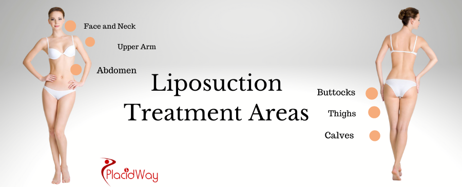 Liposuction can treat which Areas