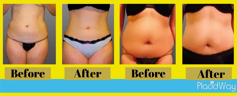 liposuction before and after