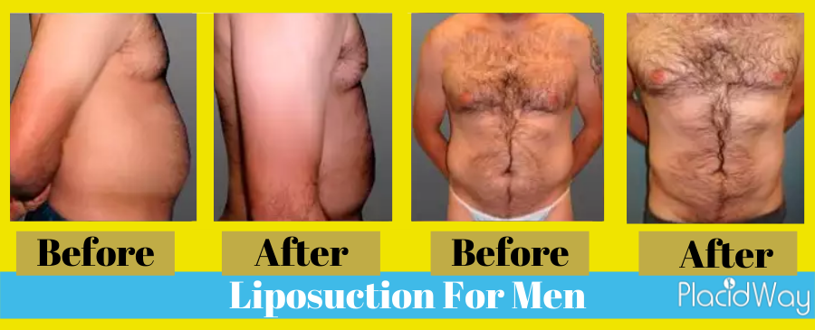liposuction before and after male Colombia