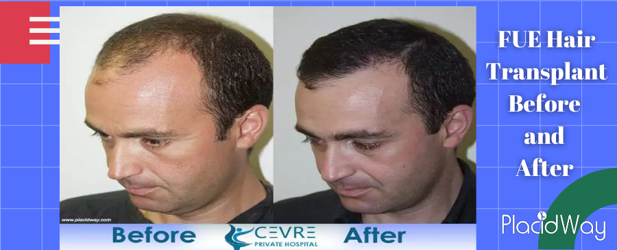 FUE hair transplant Before and After Mexico City