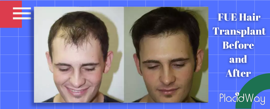 FUE hair transplant Results
