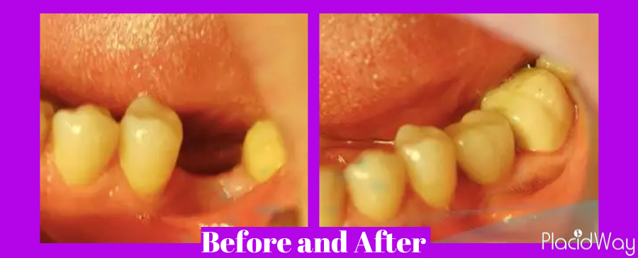 Before and After dental Implants