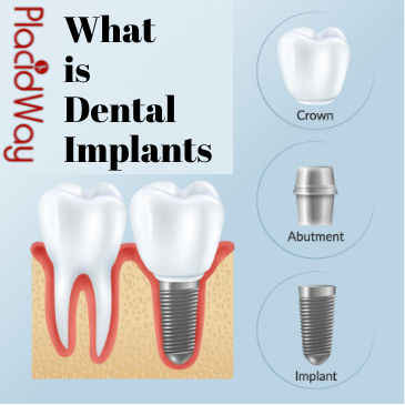 What is Dental implants