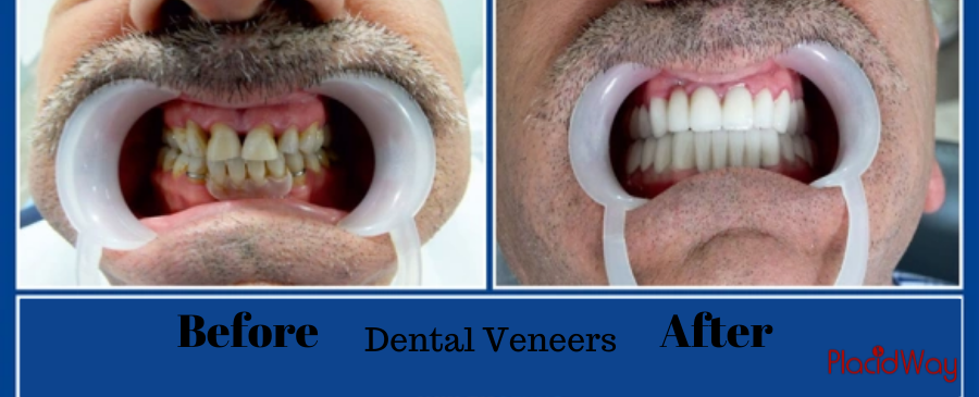 Dental Veneers Before and after in Colombia