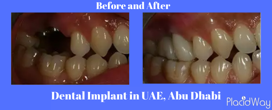  Before and After Dental Implants in UAE