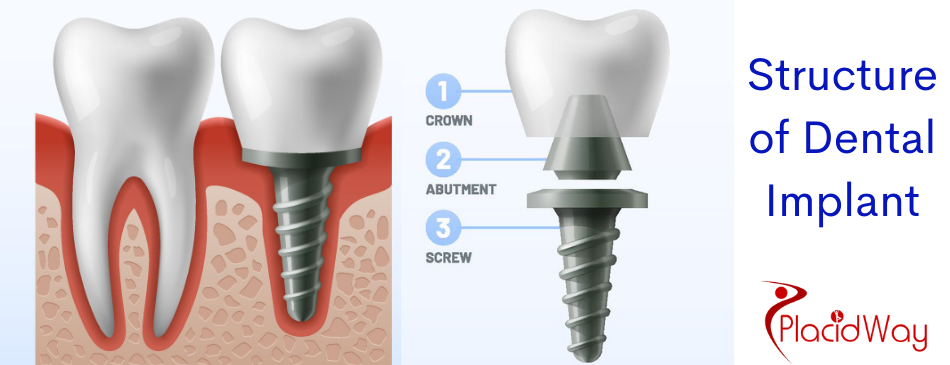 Structure of dental implants