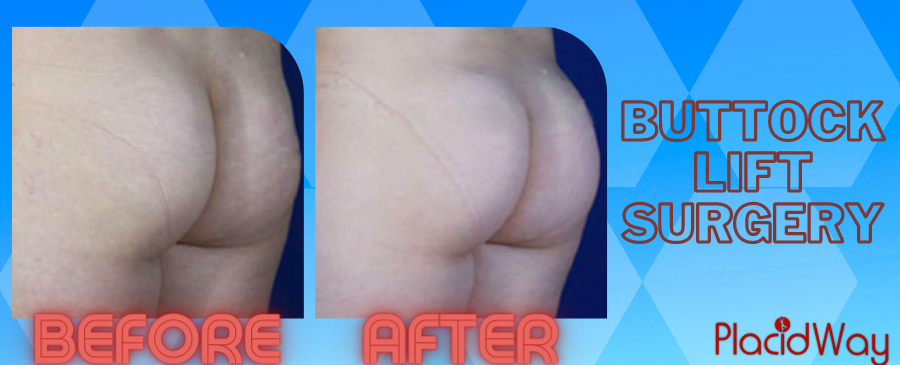 buttock lift before and after in Istanbul, Turkey