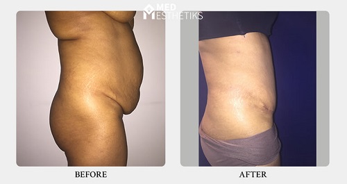 Hi Definition Liposuction Before and After