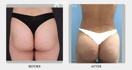 Buttock Augmentation Before and After