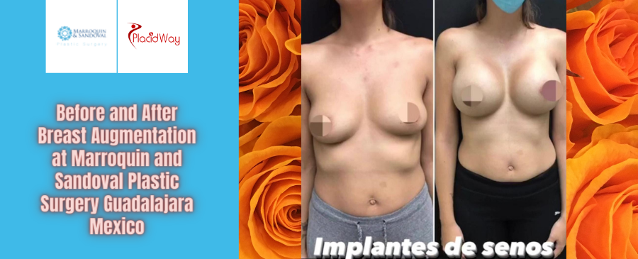 Before and After Breast Augmentation at Marroquin and Sandoval Plastic Surgery Guadalajara Mexico