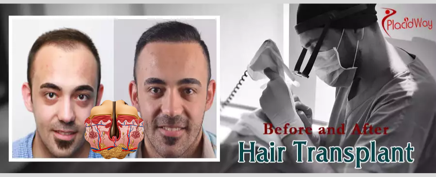 Hair Transplant Turkey Before and After Photo