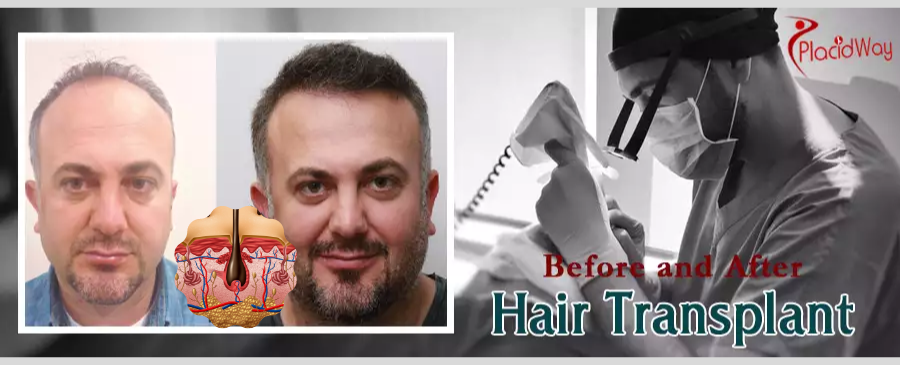 like dr arihant surana hair transplant results