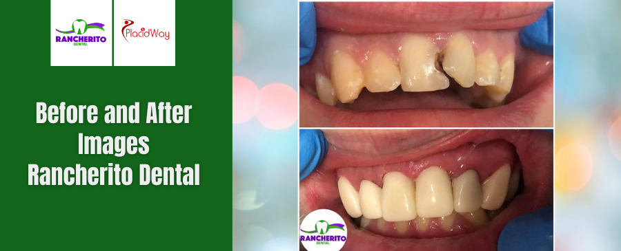 Before and After of Dental Crown in Los Algodones, Mexico