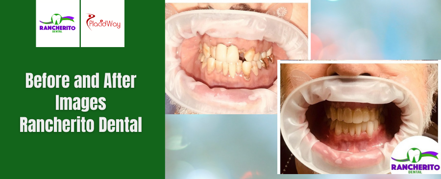 Before and After of Dental Crown in Los Algodones, Mexico