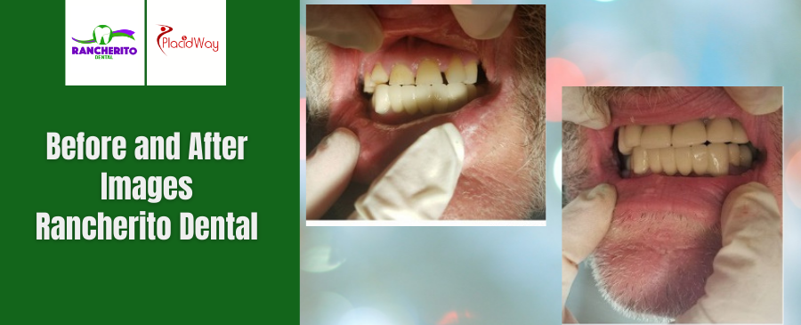 Before and After of Dental Crown in Los Algodones, Mexico