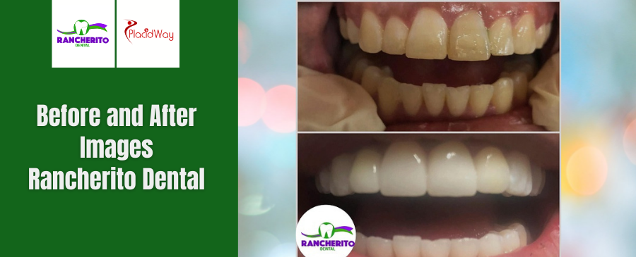Before and After of Dental Crown in Los Algodones, Mexico