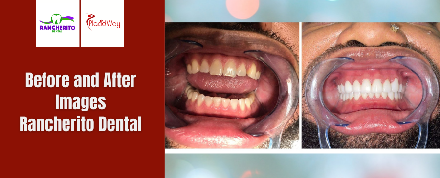 Before and After of Dental Veneers in Los Algodones, Mexico