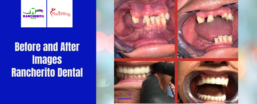 Before and After of Complete Oral Rehabilitation in Los Algodones, Mexico