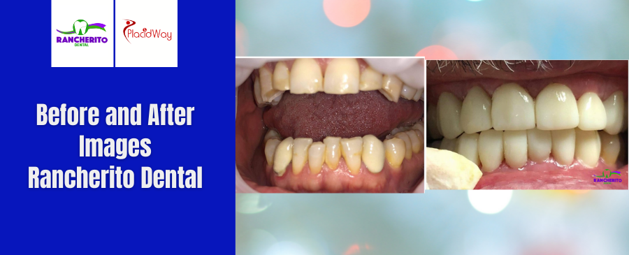 Before and After of Complete Oral Rehabilitation in Los Algodones, Mexico