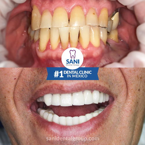 Sani Dental Group - Before and After veneers in Los Algodones