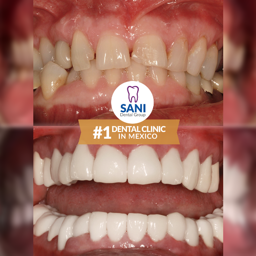 Sani Dental Group Dental Work in Los Algodones, Mexico