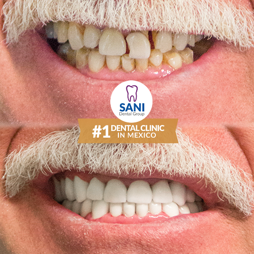 Sani Dental Group Dental Work in Los Algodones, Mexico