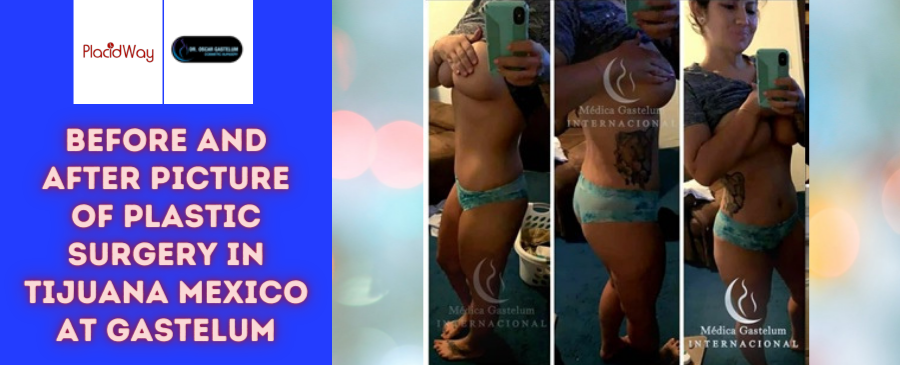 Before and After Plastic Surgery in Tijuana, Mexico