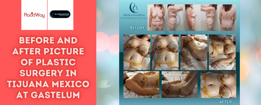 Before and After Plastic Surgery in Tijuana, Mexico