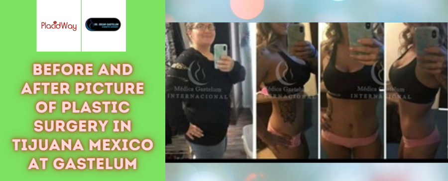Before and After Plastic Surgery in Tijuana, Mexico