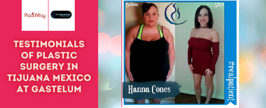 Testimonial of Cosmetic Surgery in Tijuana, Mexico