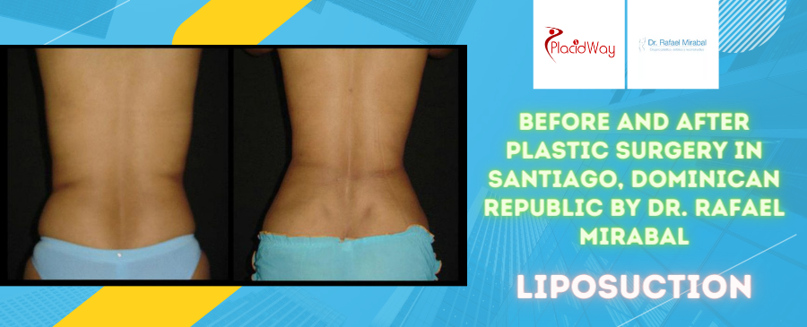 Before and After Plastic Surgery in Santiago, Dominican Republic by Dr. Rafael Mirabel Liposuction