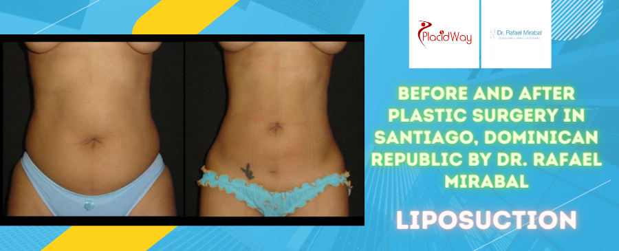 Before and After Plastic Surgery in Santiago, Dominican Republic by Dr. Rafael Mirabel Liposuction