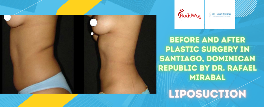 Before and After Plastic Surgery in Santiago, Dominican Republic by Dr. Rafael Mirabel Liposuction