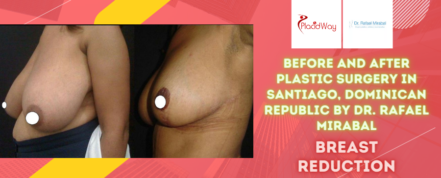 Before and After Breast Reduction Surgery in Santiago, Dominican Republic