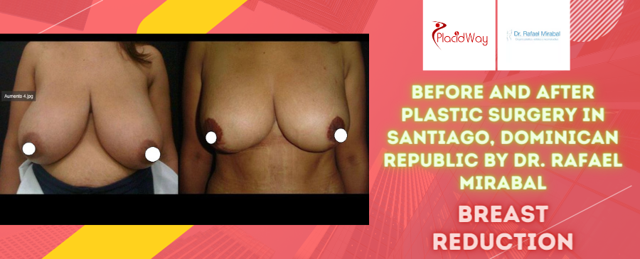 Before and After Breast Reduction Surgery in Santiago, Dominican Republic