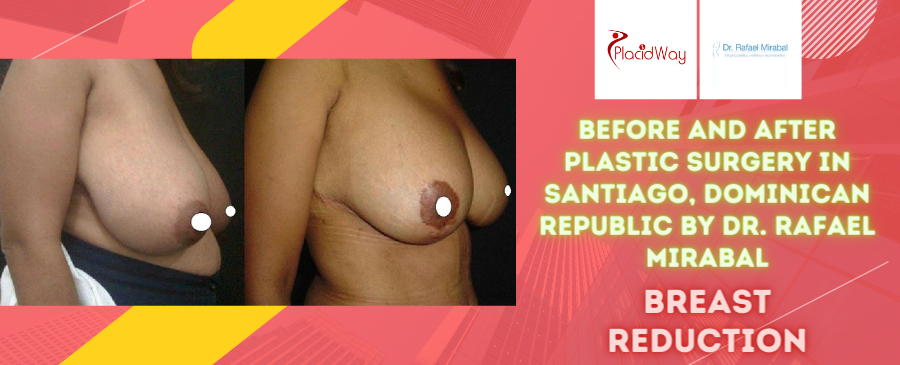 Before and After Breast Reduction Surgery in Santiago, Dominican Republic