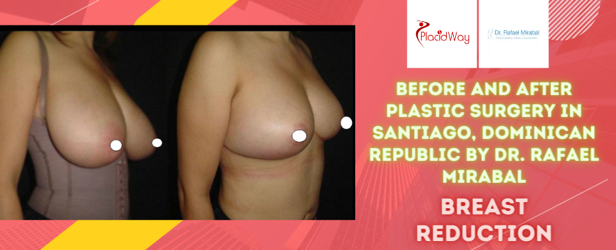 Before and After Breast Reduction Surgery in Santiago, Dominican Republic