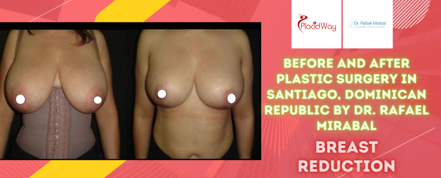 Before and After Breast Reduction Surgery in Santiago, Dominican Republic