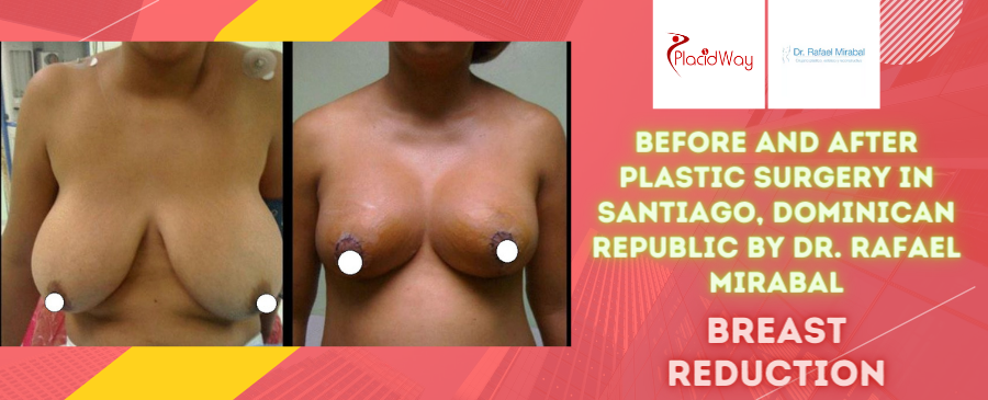 Before and After Breast Reduction Surgery in Santiago, Dominican Republic