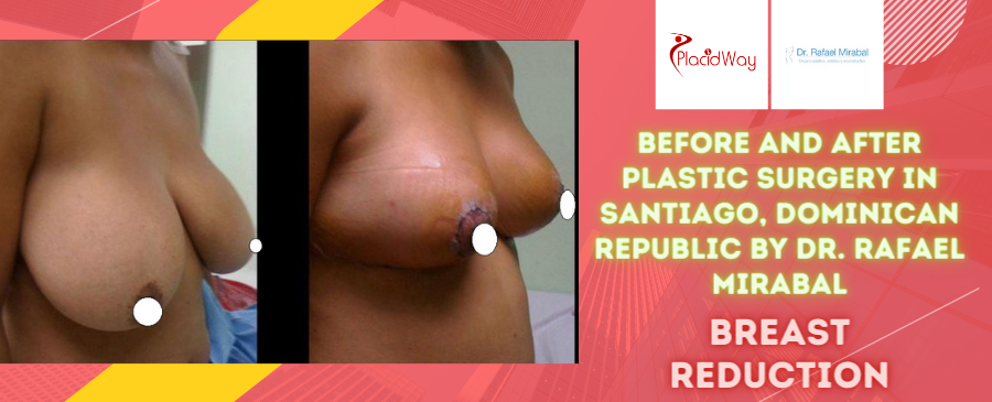 Before and After Breast Reduction Surgery in Santiago, Dominican Republic