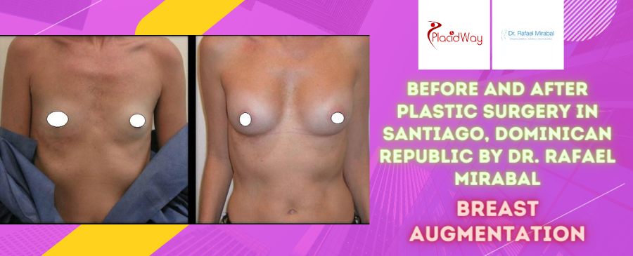 Before and After Breast Augmentation Surgery in Santiago, Dominican Republic by Dr. Rafael Mirabal